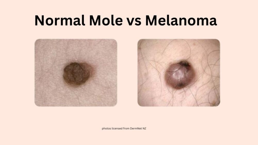 Images de mélanome – AIM at Skin Cancer Foundation