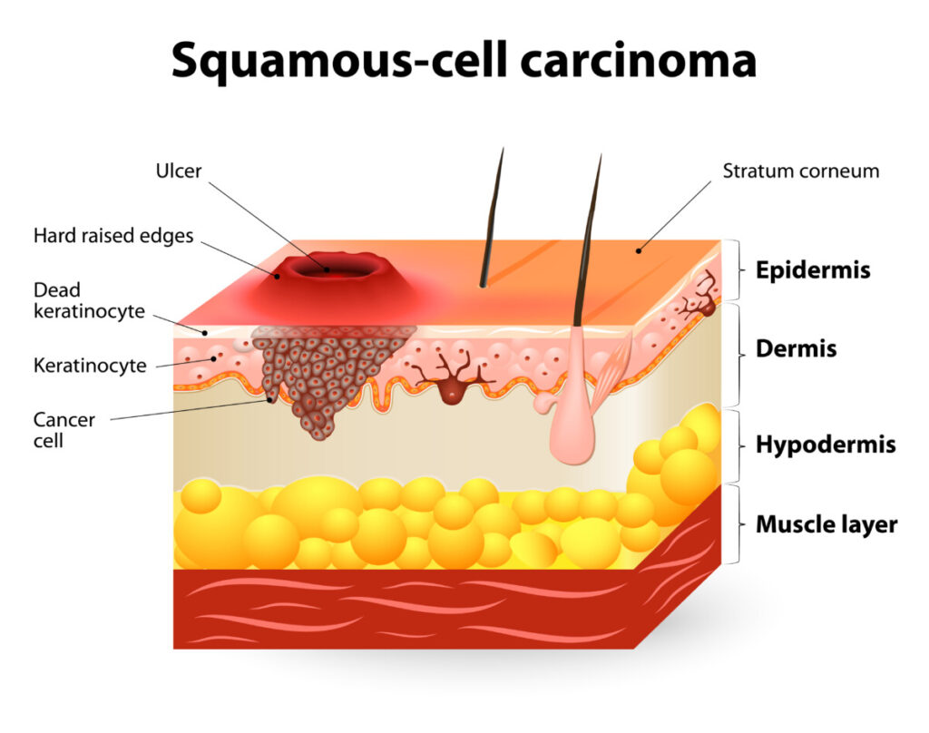 About Squamous Cell Skin Cancer AIM At Skin Cancer Foundation