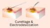 Excision Par Rasage Traitement du carcinome basocellulaire - AIM at Skin Cancer Foundation