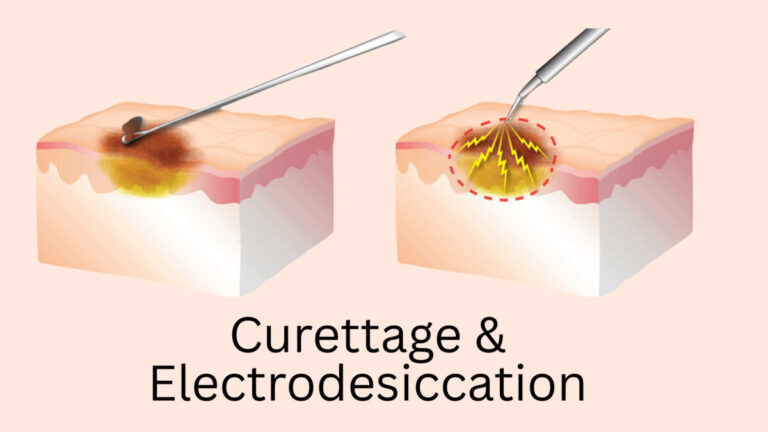 Electrodissection Traitement du carcinome basocellulaire - AIM at Skin Cancer Foundation