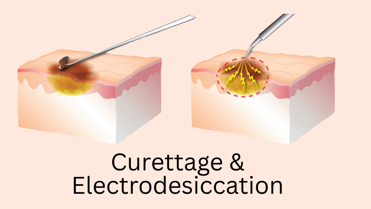 Excision Par Rasage Traitement du carcinome basocellulaire - AIM at Skin Cancer Foundation
