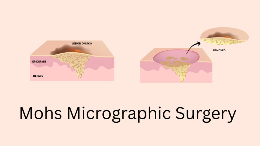 How BCC is Treated - AIM at Skin Cancer Foundation