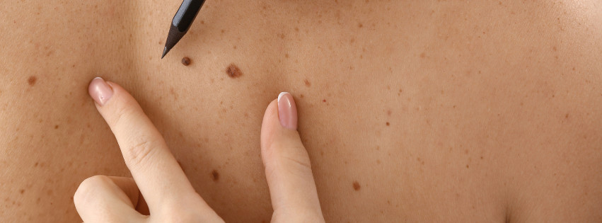 Featured image for “What Patients Should Know About the Rising Rates of Skin Cancer”